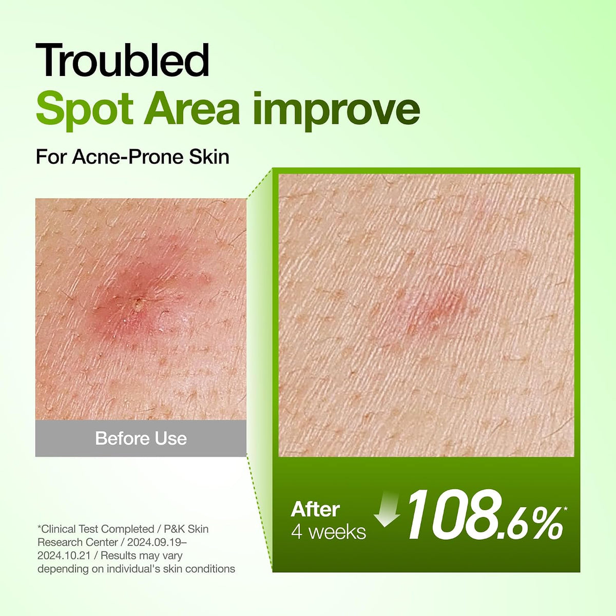 Anua Azelaic Acid 10 Hyaluron Redness Soothing Serum